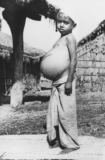 Child with inflated spleen due to malaria