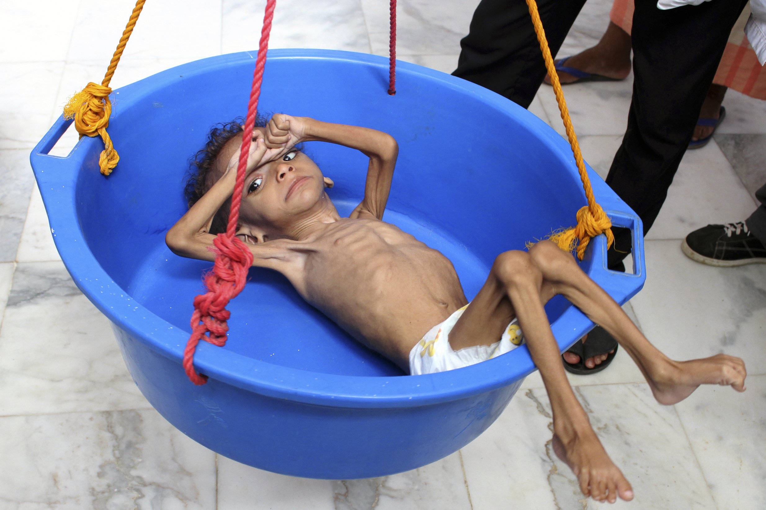 A Yemeni child suffering from malnutrition is weighed at a hospital