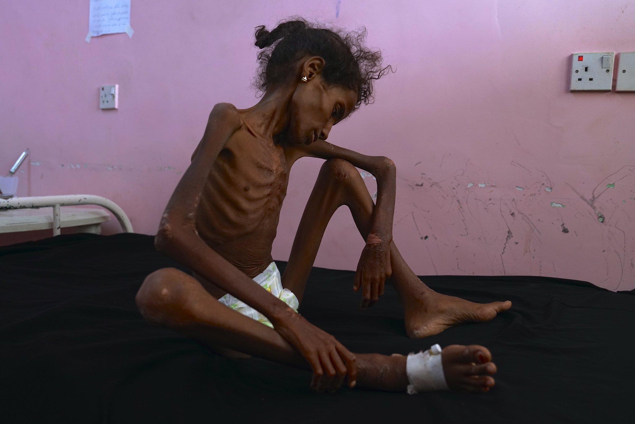 Abrar Ibrahim, a 12-year-old girl in Yemen who weighs just 28 pounds